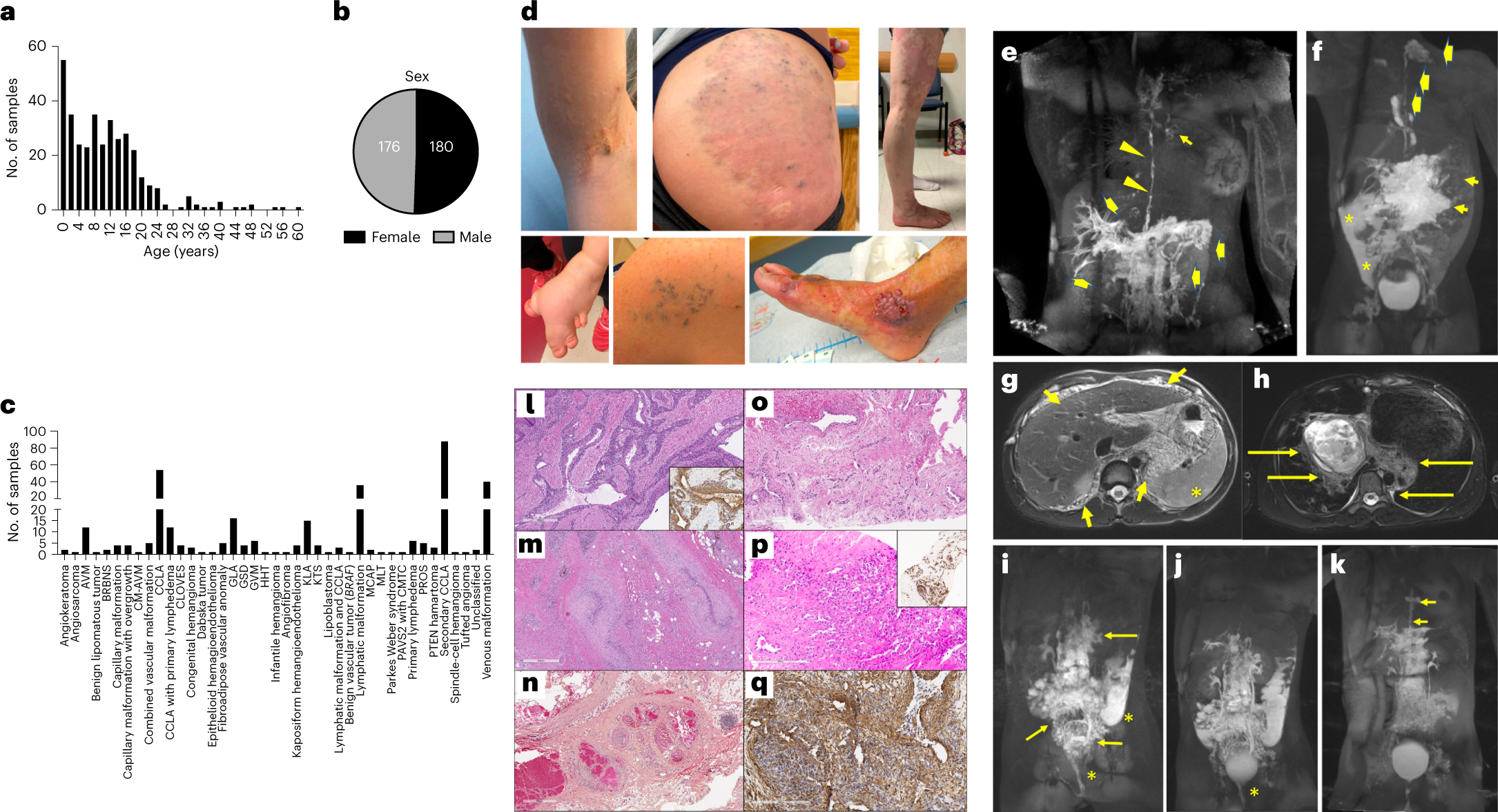 Genomic profiling informs diagnoses and treatment in vascular anomalies