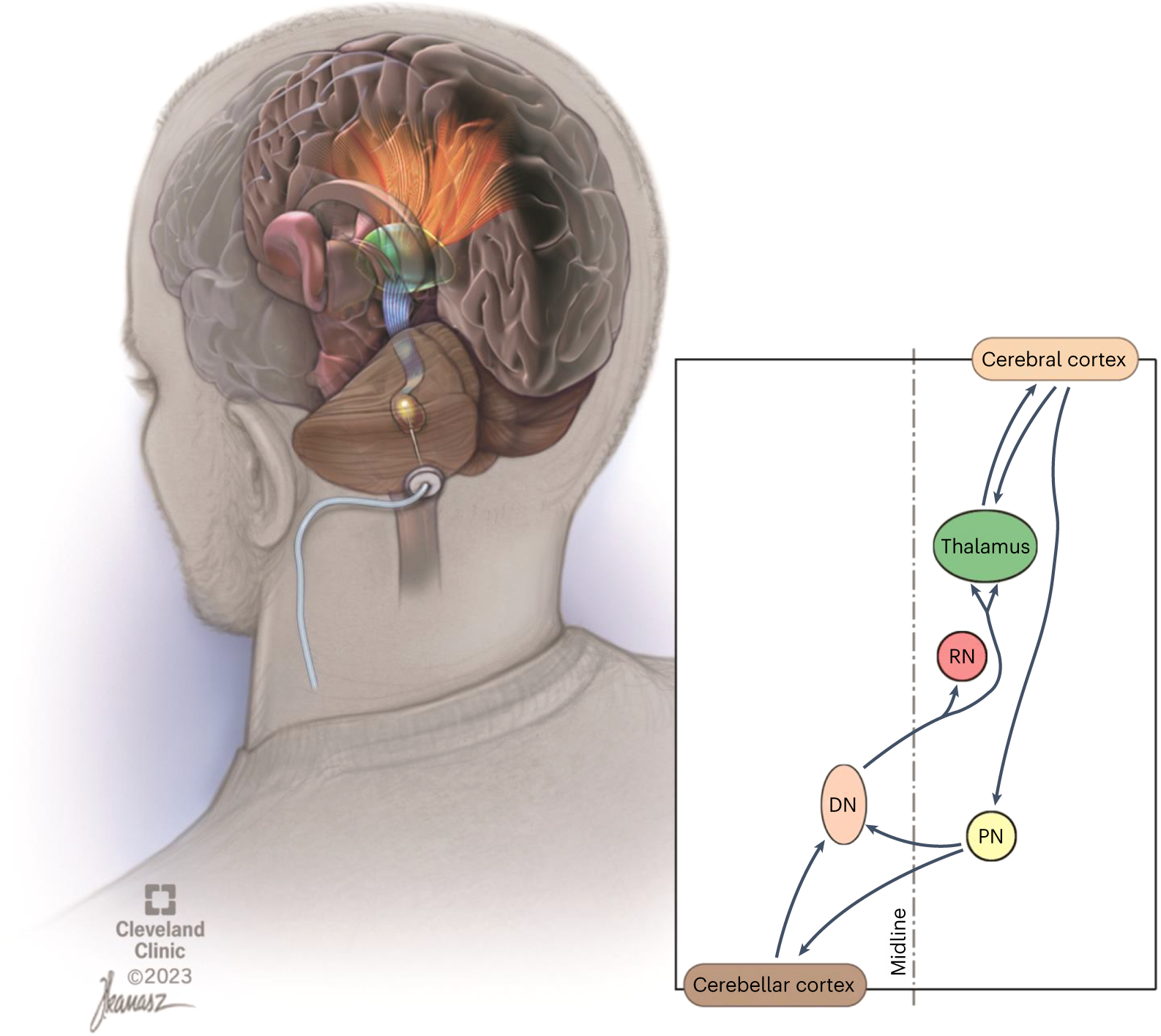 Cerebellar deep brain stimulation for chronic post-stroke motor  rehabilitation: a phase I trial