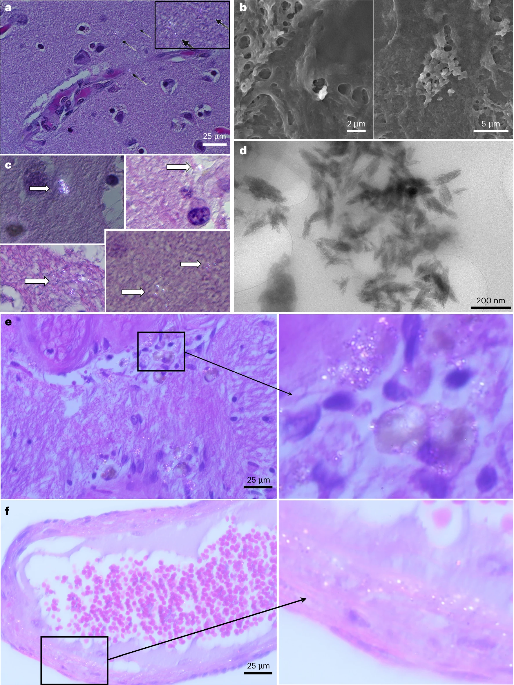 Visualização de plásticos no cérebro, in "Bioaccumulation of microplastics in decedent human brains"