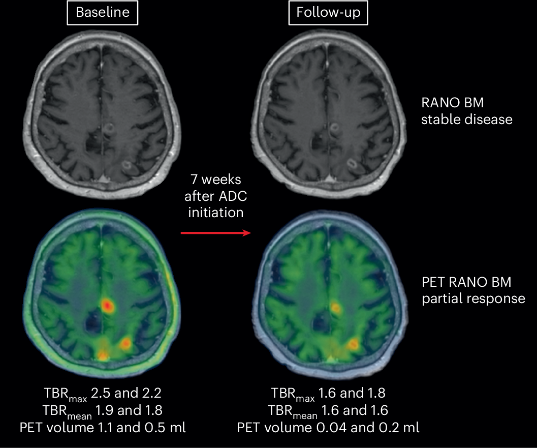 アミノ酸PETによる脳転移の標準診断基準の策定(Nuclear medicine: better diagnosis and therapy for brain metastases) アミノ酸PETによる脳転移の標準診断基準の策定(Nuclear medicine: better diagnosis and therapy for brain metastases)