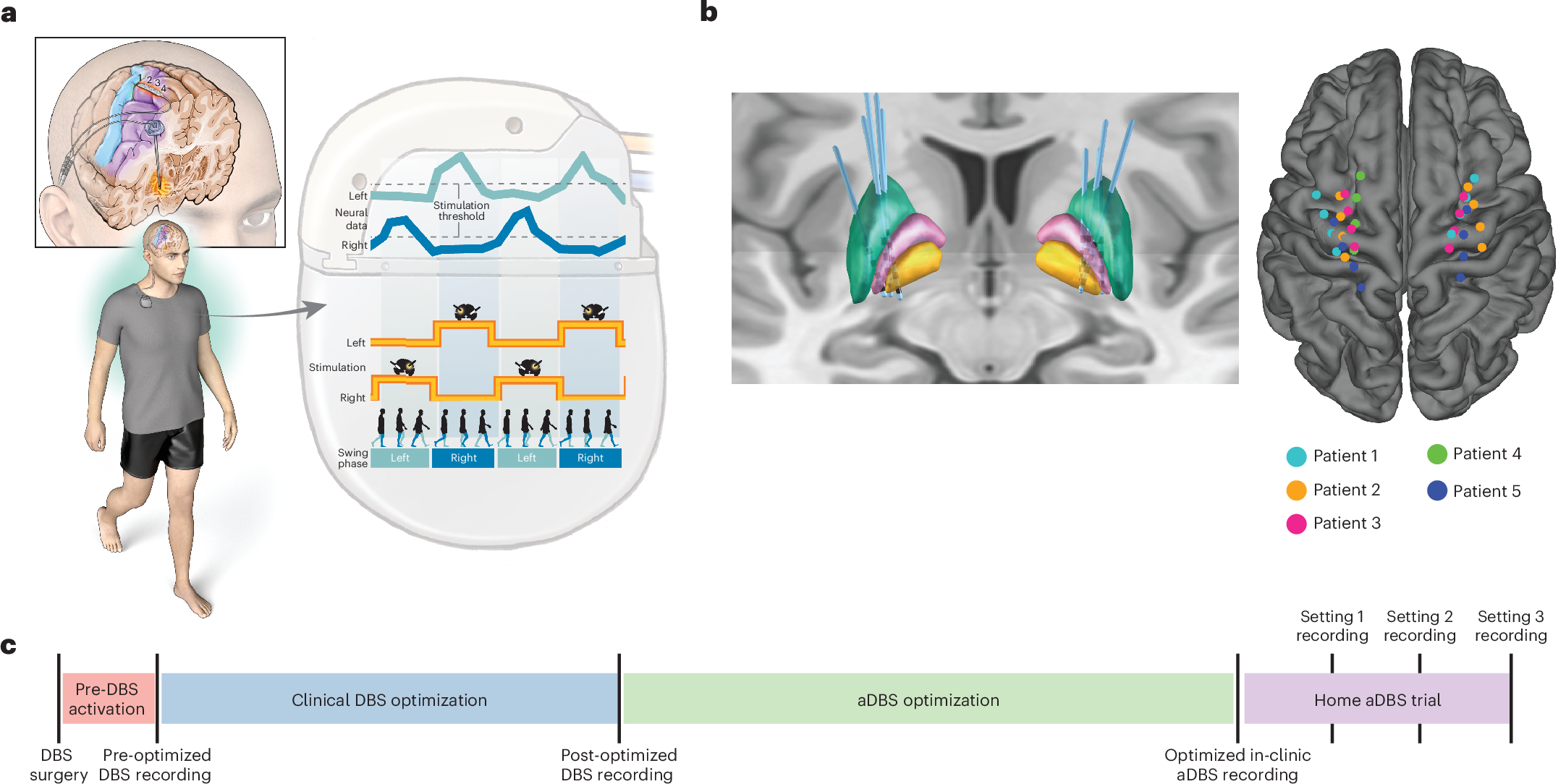 El cerebro lleva un ritmo al caminar, y ahora un implante lo sigue paso a paso