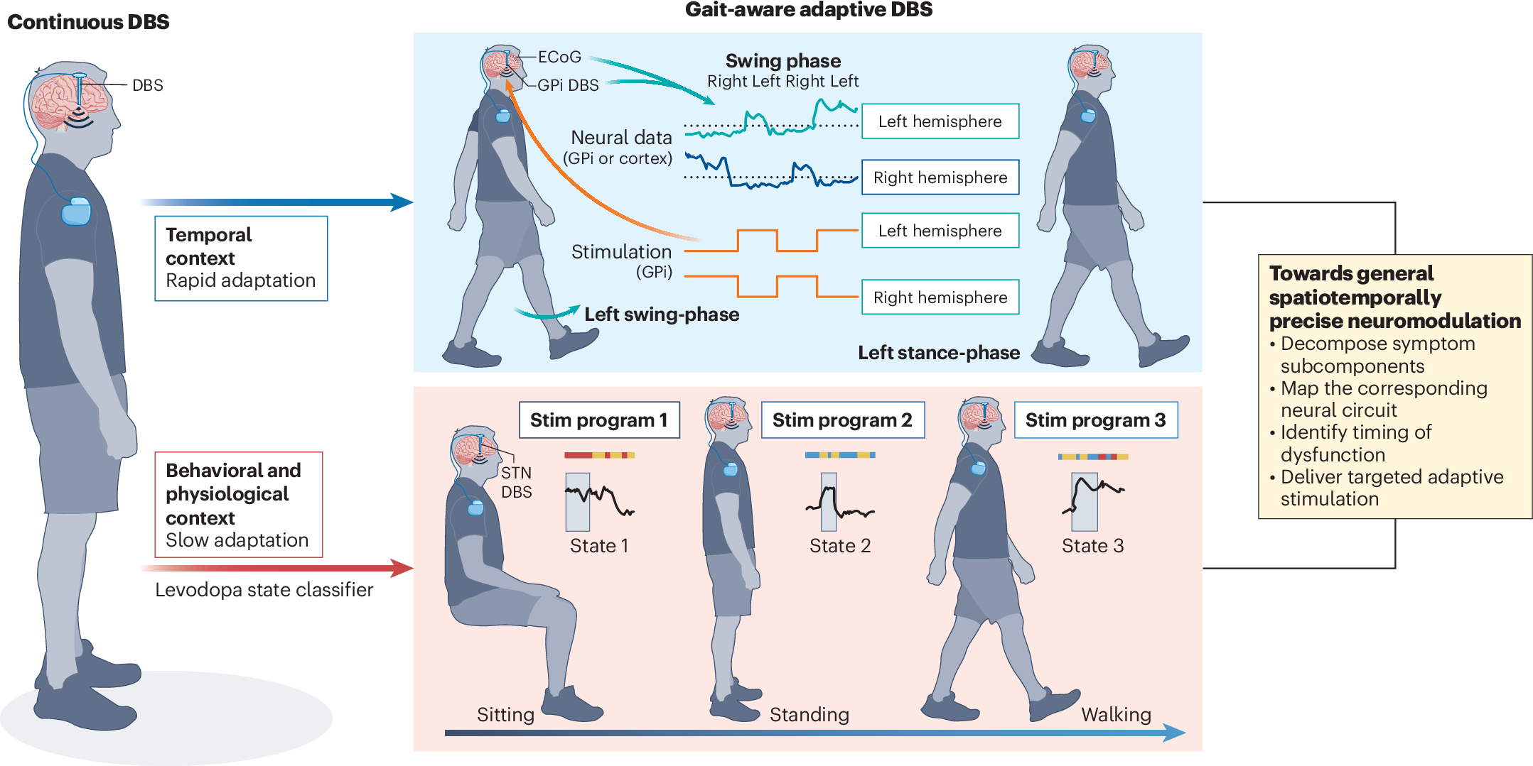 Adaptive brain stimulation 2.0 for Parkinsonian gait | Nature Medicine