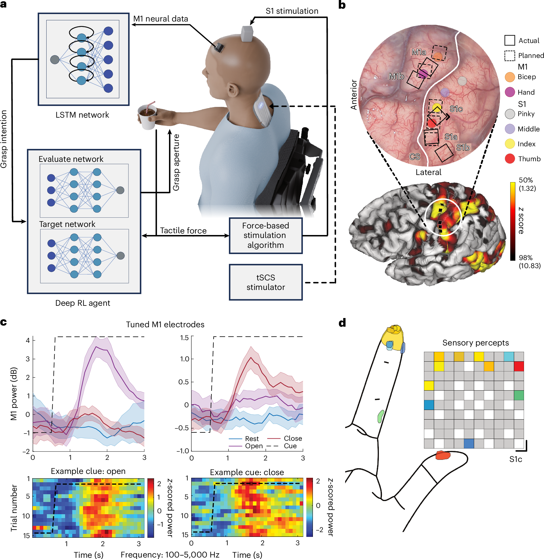 A neuroprosthesis for restoring hand movement and sensation in a person with complete tetraplegia