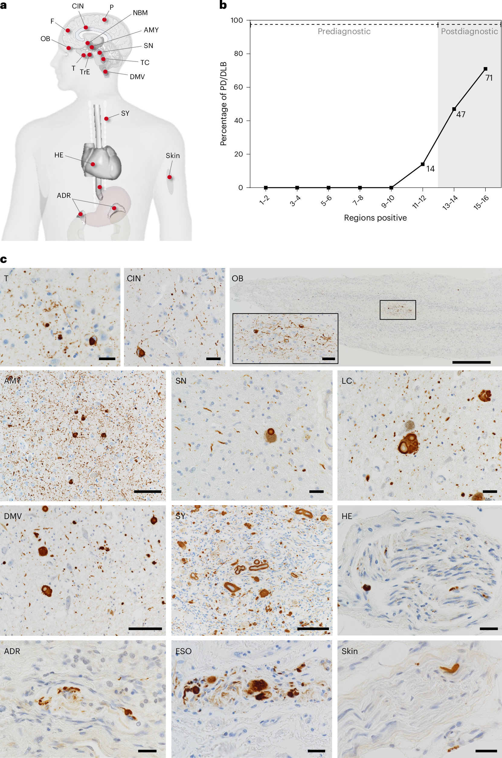 Fig. 1: Postmortem data and immunohistochemistry photomicrographs.