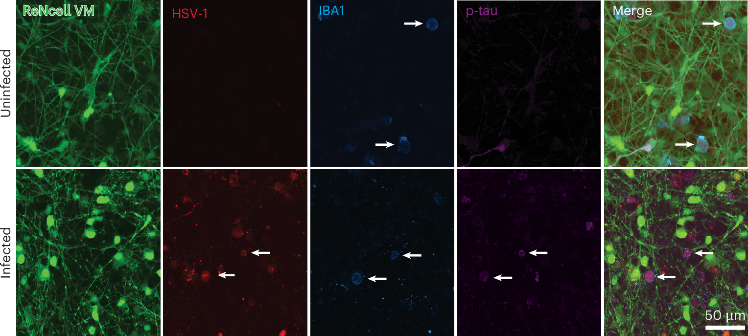 Fig. 7: p-tau and HSV-1 co-localize inside microglia.