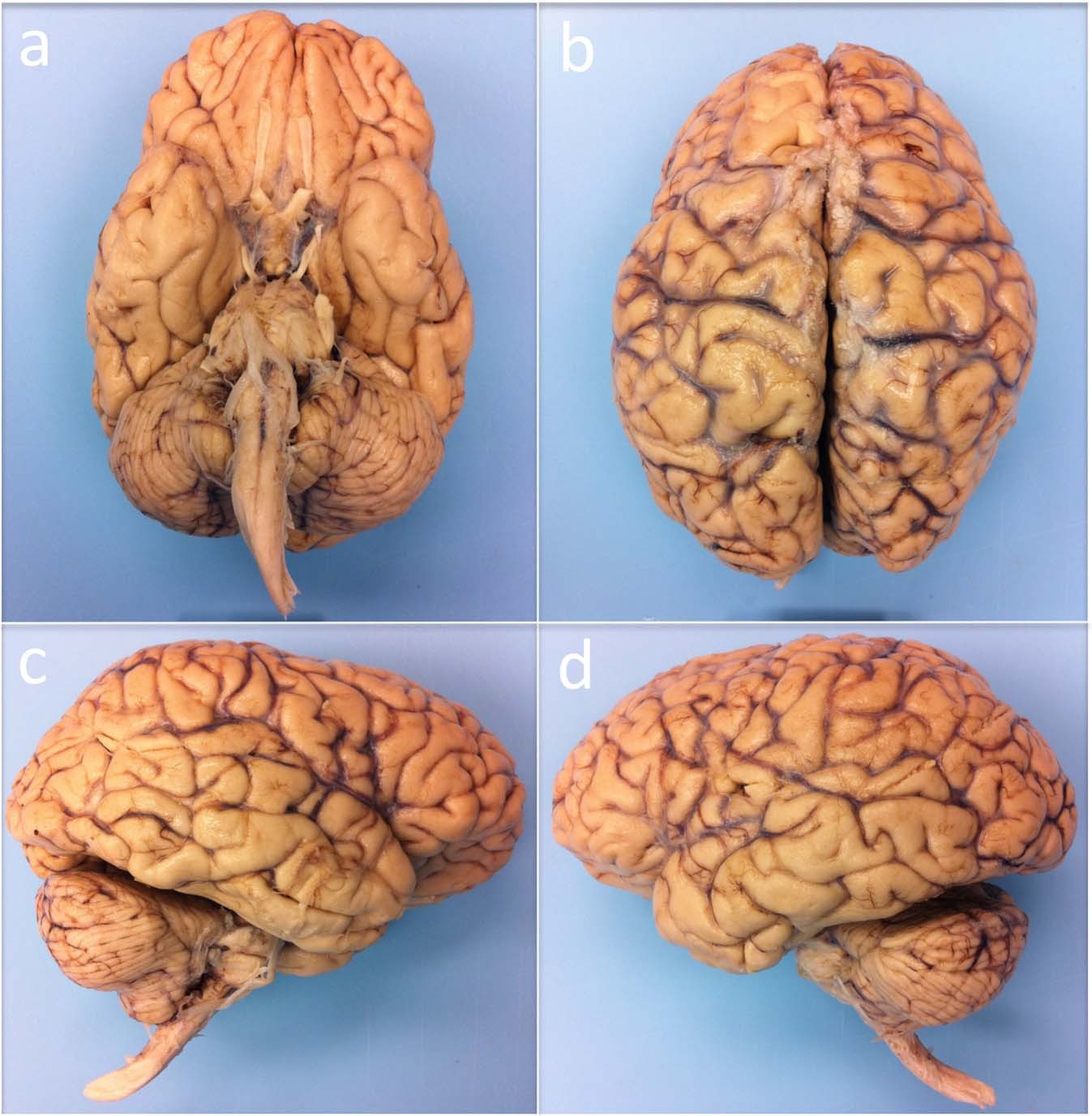 7 Tesla Mri Of The Ex Vivo Human Brain At 100 Micron