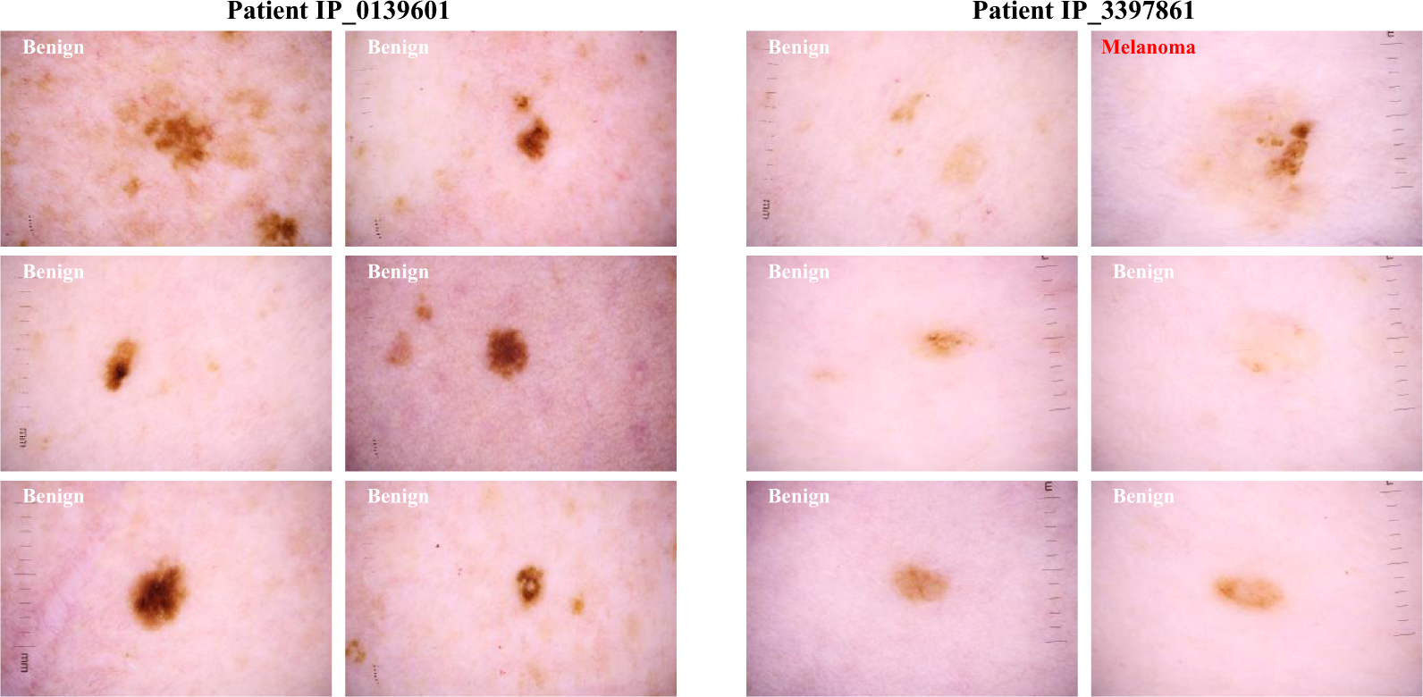 A patient-centric dataset of images and metadata for identifying melanomas  using clinical context | Scientific Data