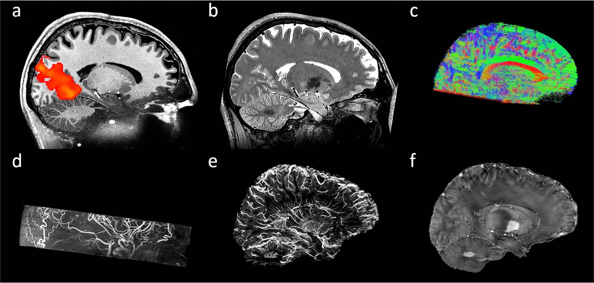 Brain MRI: What It Is, Purpose, Procedure & Results