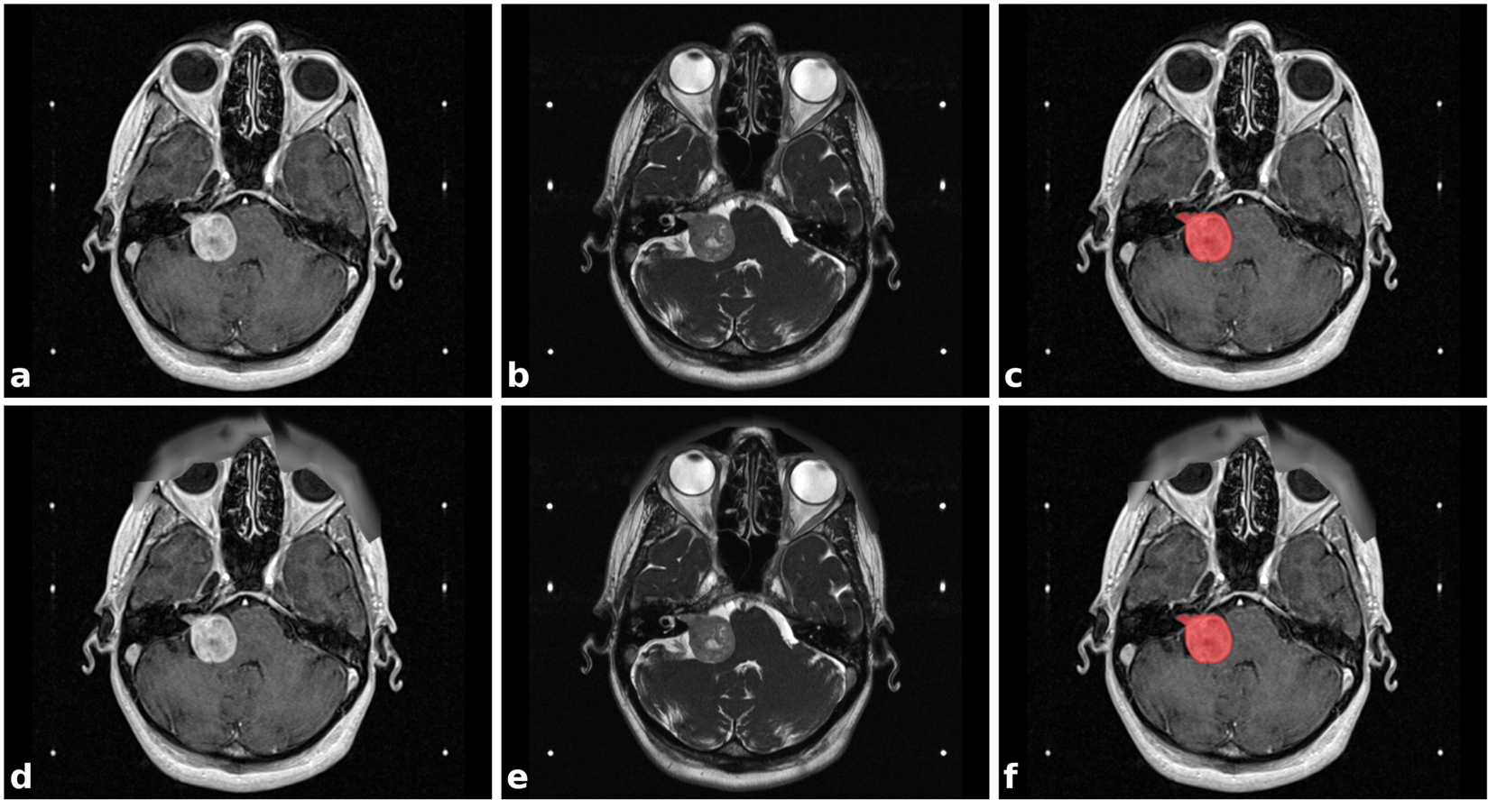 Segmentation of vestibular schwannoma from MRI, an open annotated dataset  and baseline algorithm | Scientific Data