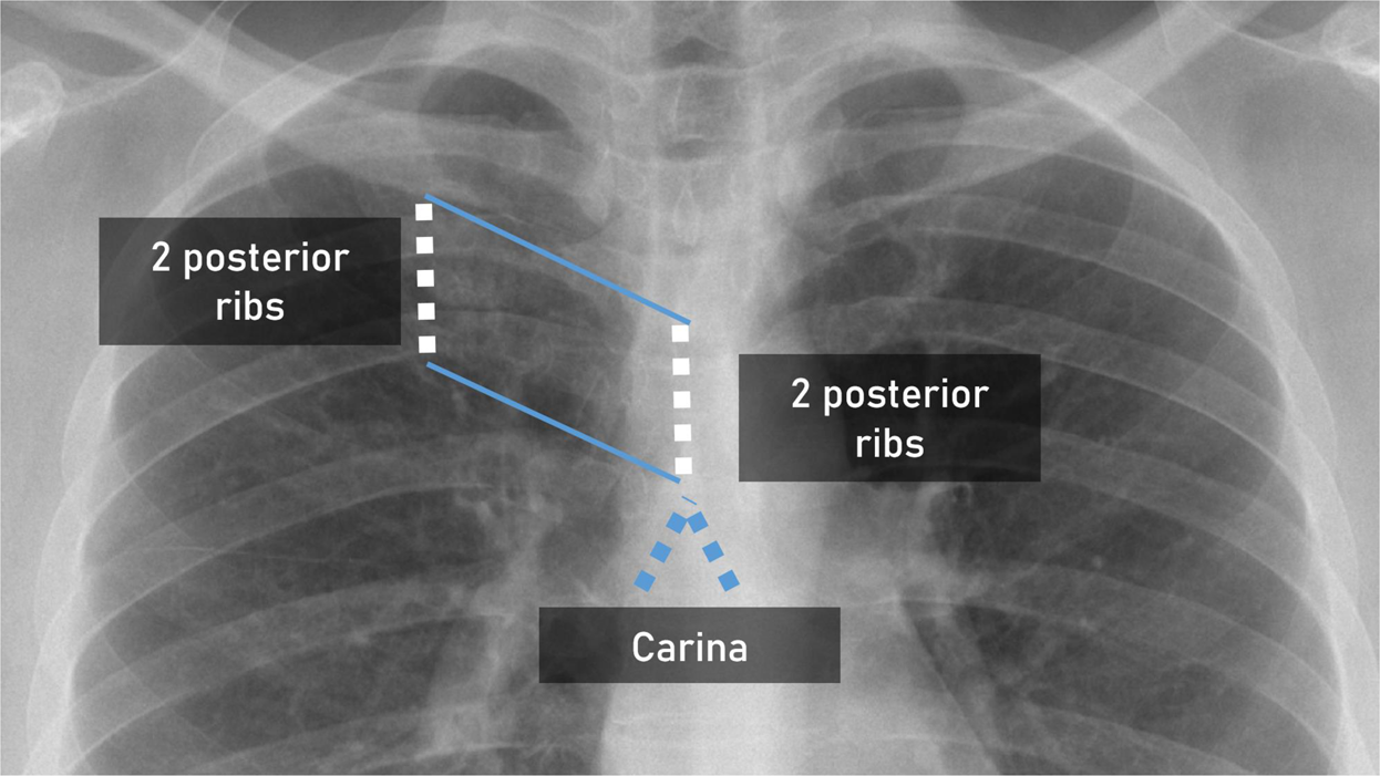 normal chest xray labeled