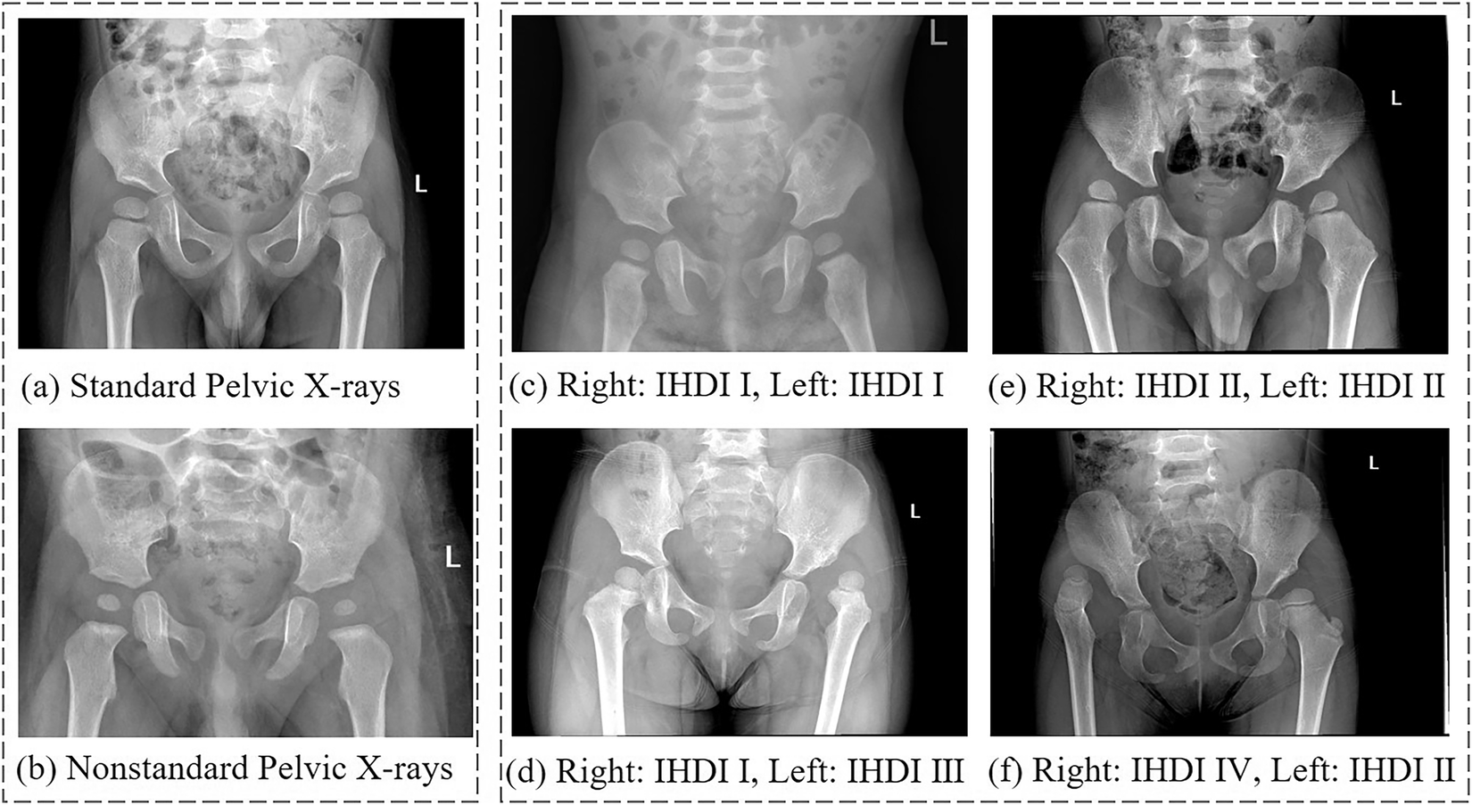 A dataset for quality evaluation of pelvic X-ray and diagnosis of  developmental dysplasia of the hip | Scientific Data