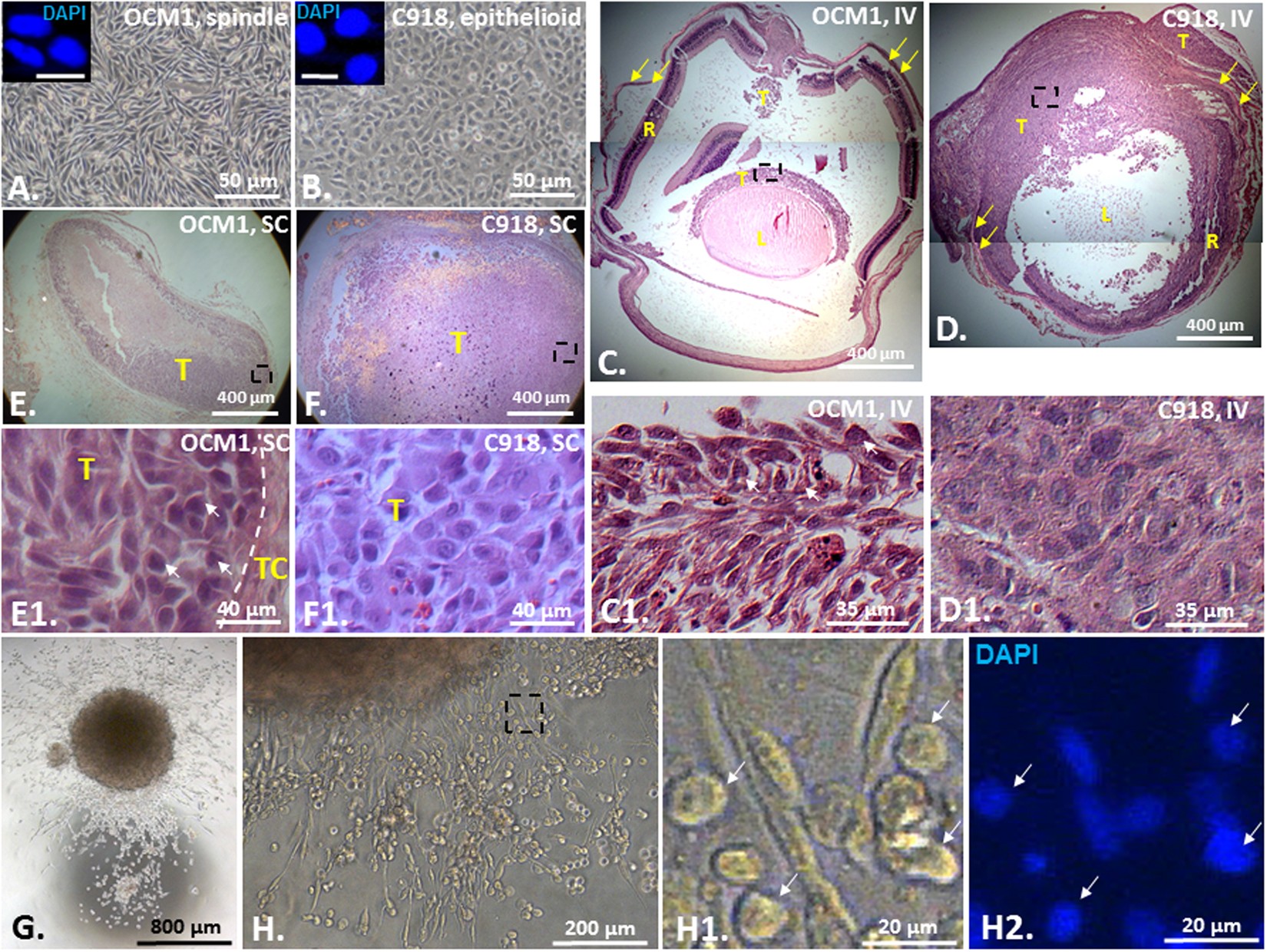 ZEB1 Regulates Multiple Oncogenic Components Involved in Uveal Melanoma  Progression | Scientific Reports