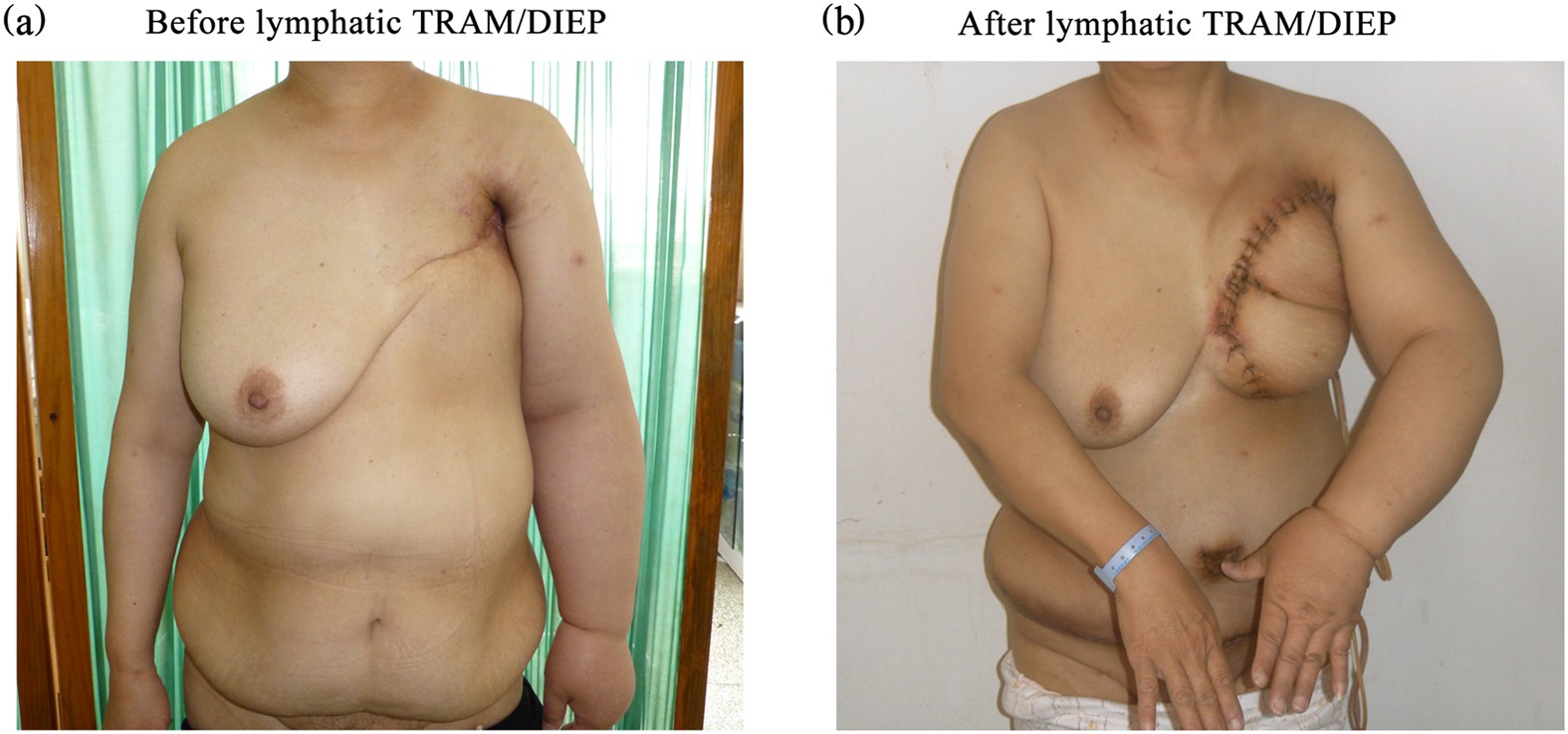 A retrospective study of lymphatic transverse rectus abdominis myocutaneous/deep  inferior epigastric perforator flaps for breast cancer treatment-induced  upper-limb lymphoedema | Scientific Reports
