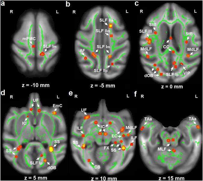 Developmental Whole Brain White Matter Alterations In