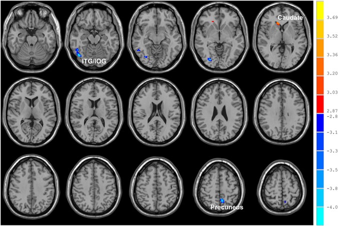 can you smoke cigarettes before an mri Altered spontaneous brain activity in chronic smokers revealed by  fractional ramplitude of low-frequency fluctuation analysis: a preliminary  study
