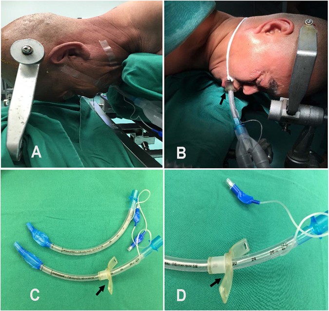 A randomized comparison of the prone ventilation endotracheal tube versus  the traditional endotracheal tube in adult patients undergoing prone  position surgery | Scientific Reports