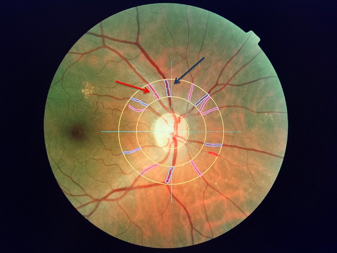 Comparisons Of Microvascular And Macrovascular Changes In Aldosteronism Related Hypertension And Essential Hypertension Scientific Reports