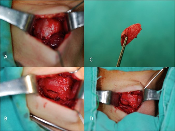 Autologous thyroid cartilage graft implantation in medialization  laryngoplasty: a modified approach for treating unilateral vocal fold  paralysis | Scientific Reports