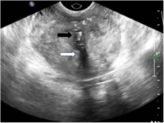 prostate calcification ultrasound images