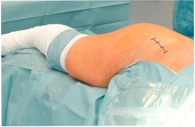 Trainee Surgeons Affect Operative Time But Not Outcome In Minimally  Invasive Total Hip Arthroplasty | Scientific Reports