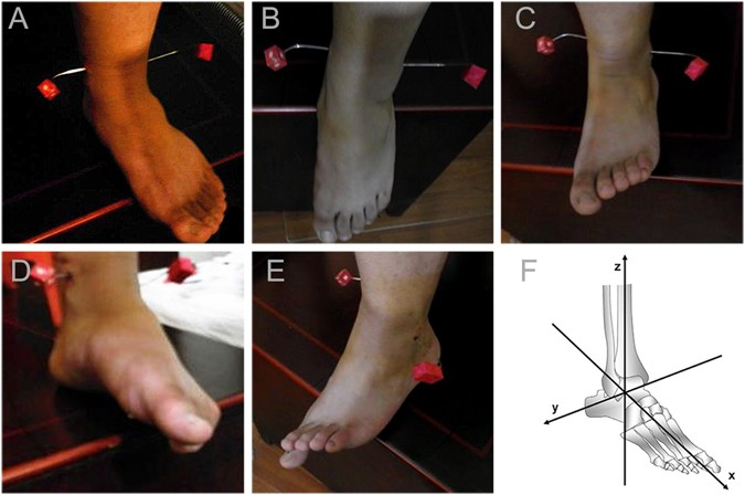 JBJS: The Ligament Anatomy of the Deltoid Complex of the Ankle: A  Qualitative and Quantitative Anatomical Study