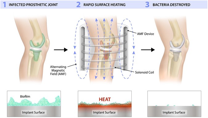 Employing high-frequency alternating magnetic fields for the non-invasive  treatment of prosthetic joint infections | Scientific Reports