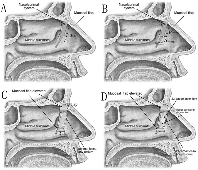 A Modified Preserved Nasal and Lacrimal Flap Technique in Endoscopic  Dacryocystorhinostomy | Scientific Reports