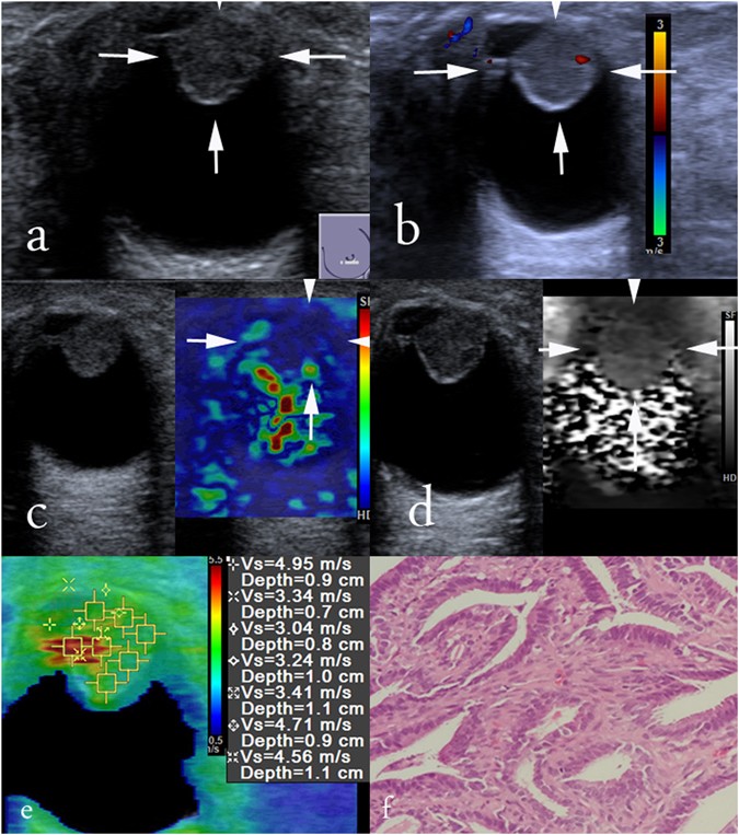 Virtual Touch Tissue Imaging And Quantification Value In Malignancy Prediction For Complex Cystic And Solid Breast Lesions Scientific Reports