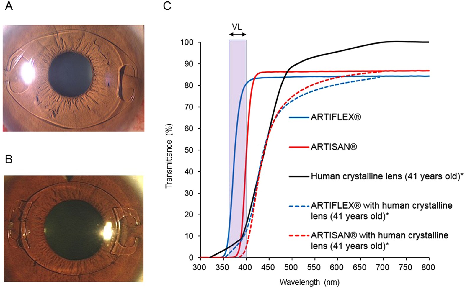 Violet Light Transmission is Related to Myopia Progression in Adult High  Myopia | Scientific Reports