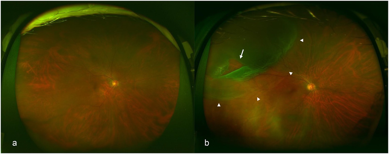 Ultra-wide-field fundus photographs and ultra-wide-field