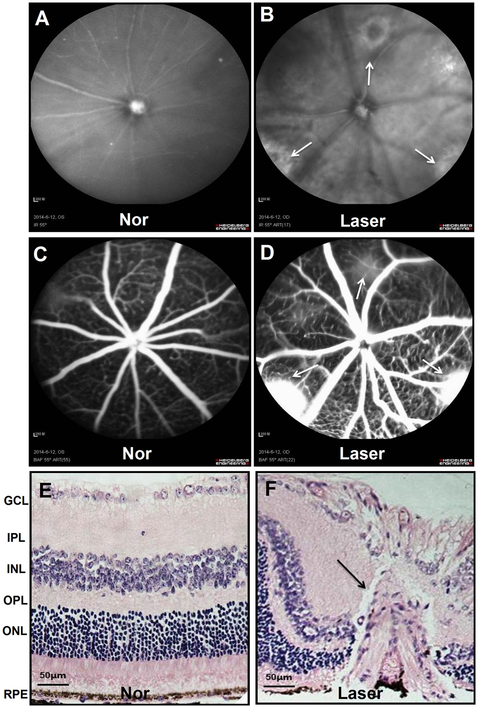 TGF-β participates choroid neovascularization through Smad2/3-VEGF/TNF-α  signaling in mice with Laser-induced wet age-related macular degeneration