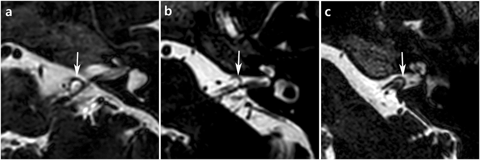Typewriter Tinnitus Revisited The Typical Symptoms And The