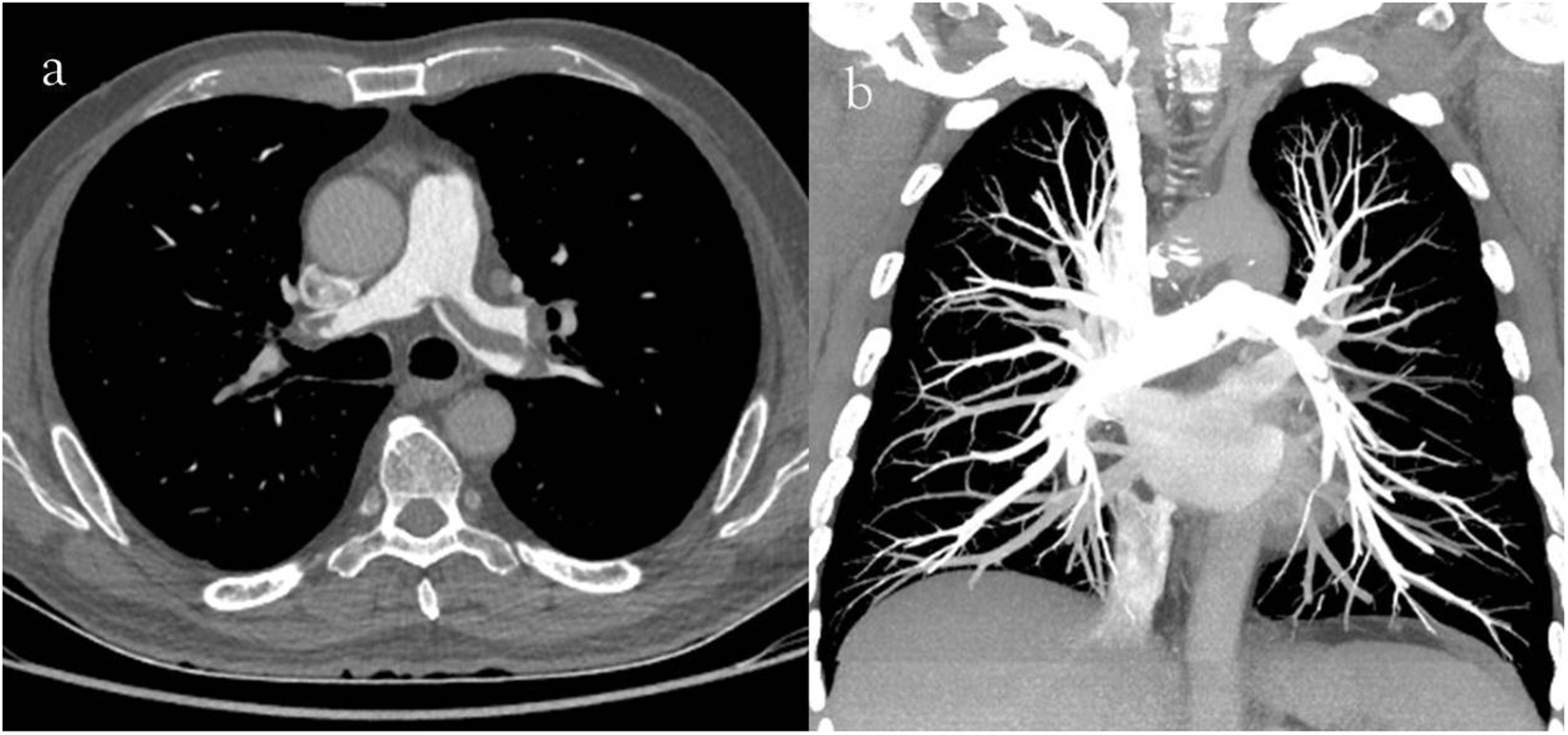 Blood clots: Pre-embolization 80 from 270 participants reported passing