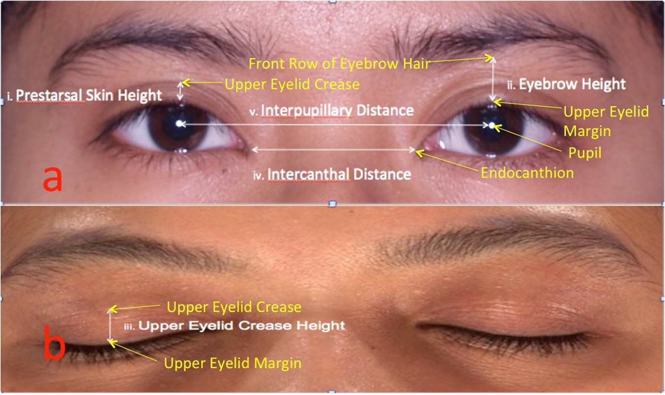 The Prevalence of Double Eyelid and the 3D Measurement of Orbital Soft  Tissue in Malays and Chinese | Scientific Reports
