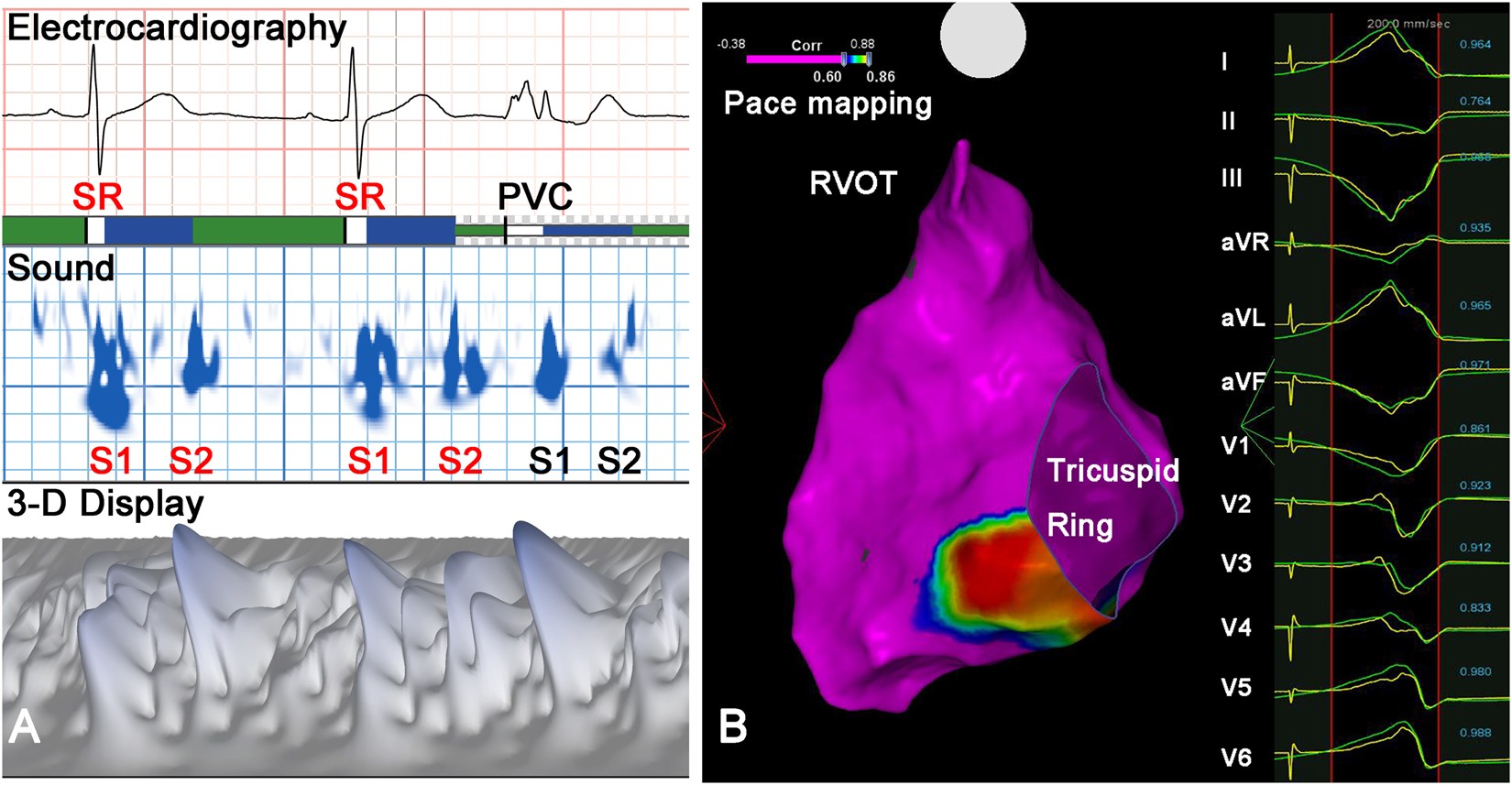 Predicting the Origin of Ventricular Arrhythmia Using Acoustic Cardiography  | Scientific Reports