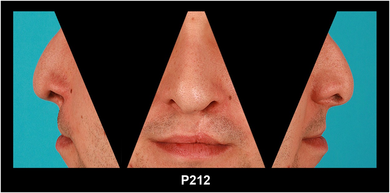 Facial Aesthetics in Young Adults after Cleft Lip and Palate Treatment over  Five Decades | Scientific Reports