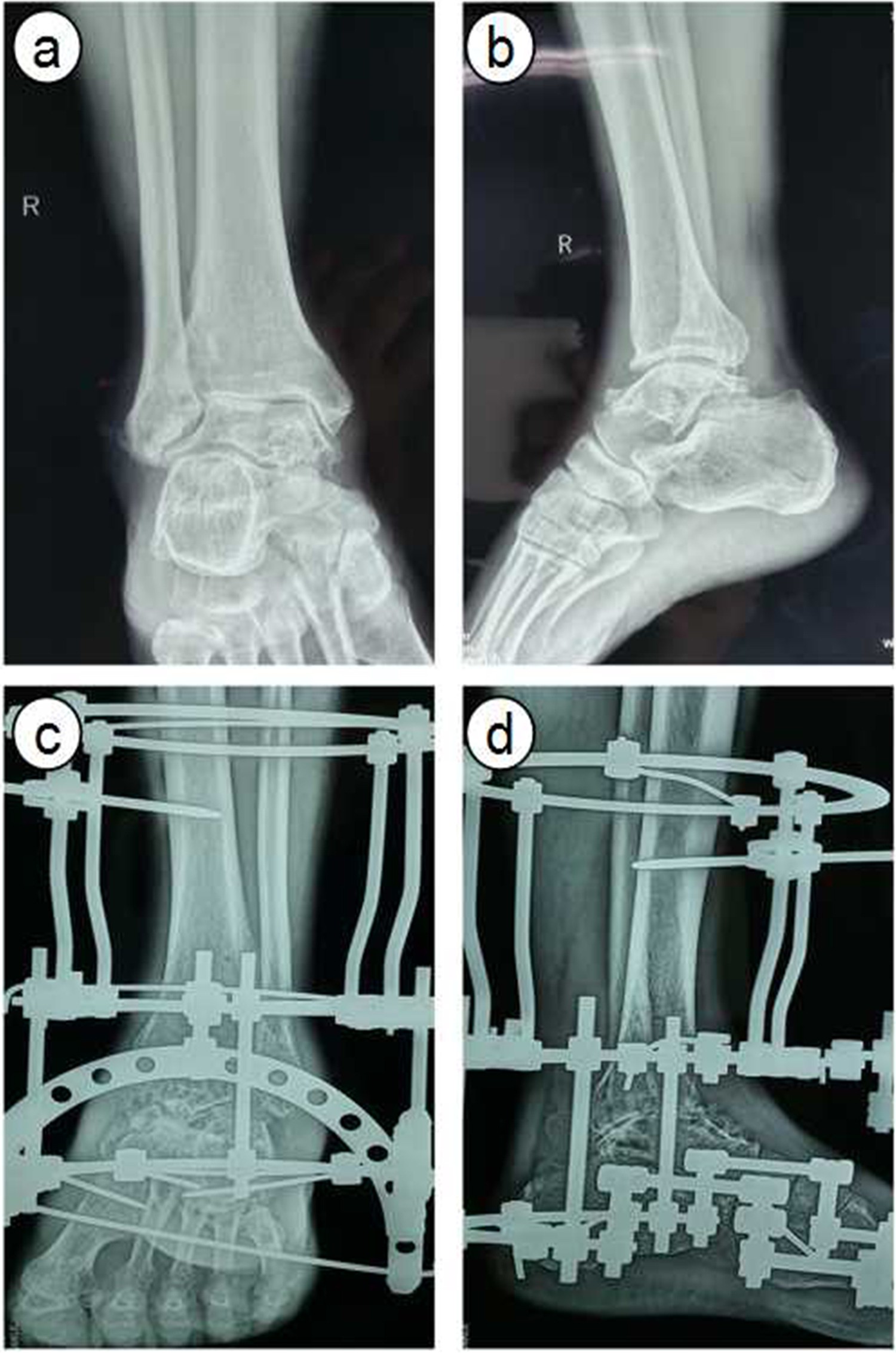 Ilizarov external fixation versus plate internal fixation in the treatment  of end-stage ankle arthritis: decision analysis of clinical parameters |  Scientific Reports