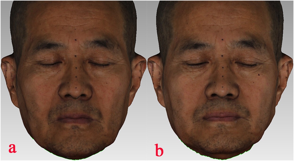 Prediction Of Aesthetic Reconstruction Effects In Edentulous Patients Scientific Reports