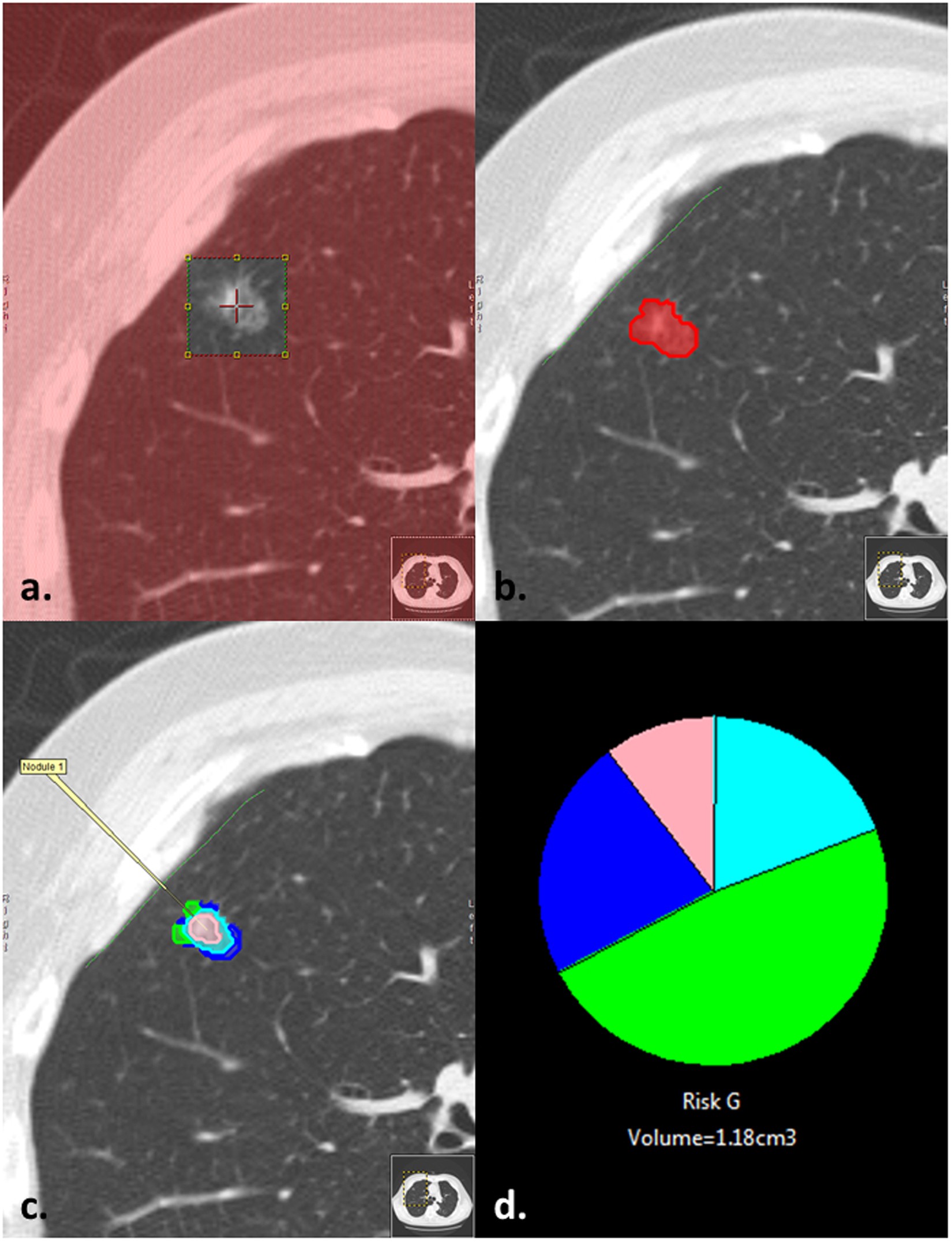 Computer Aided Nodule Assessment And Risk Yield Canary May