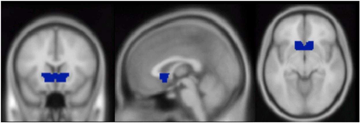 Neural Correlates of Sexual Orientation in Heterosexual, Bisexual, and Homosexual Women Scientific Reports