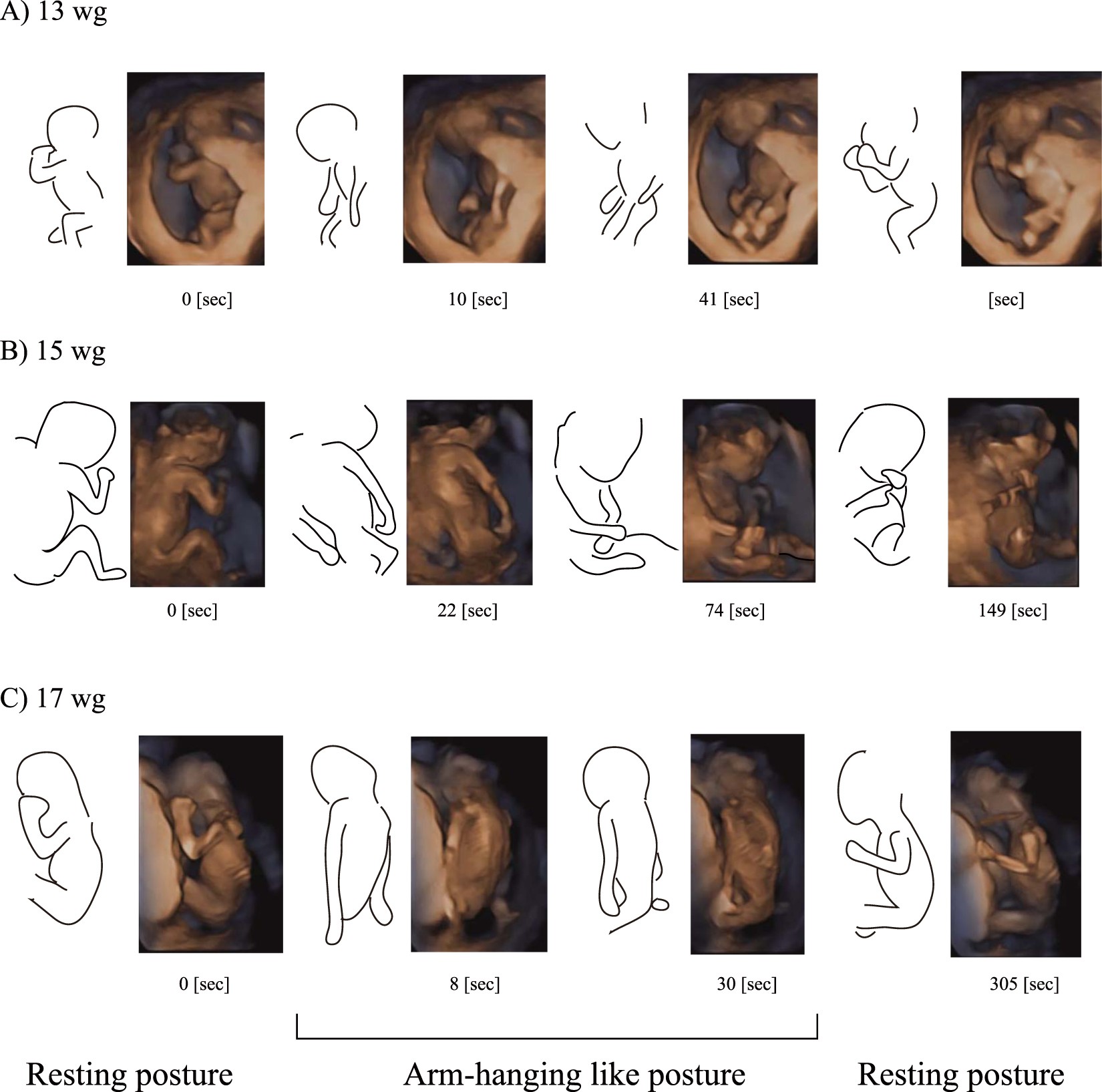 Species-specific Posture of Human Foetus in Late First Trimester