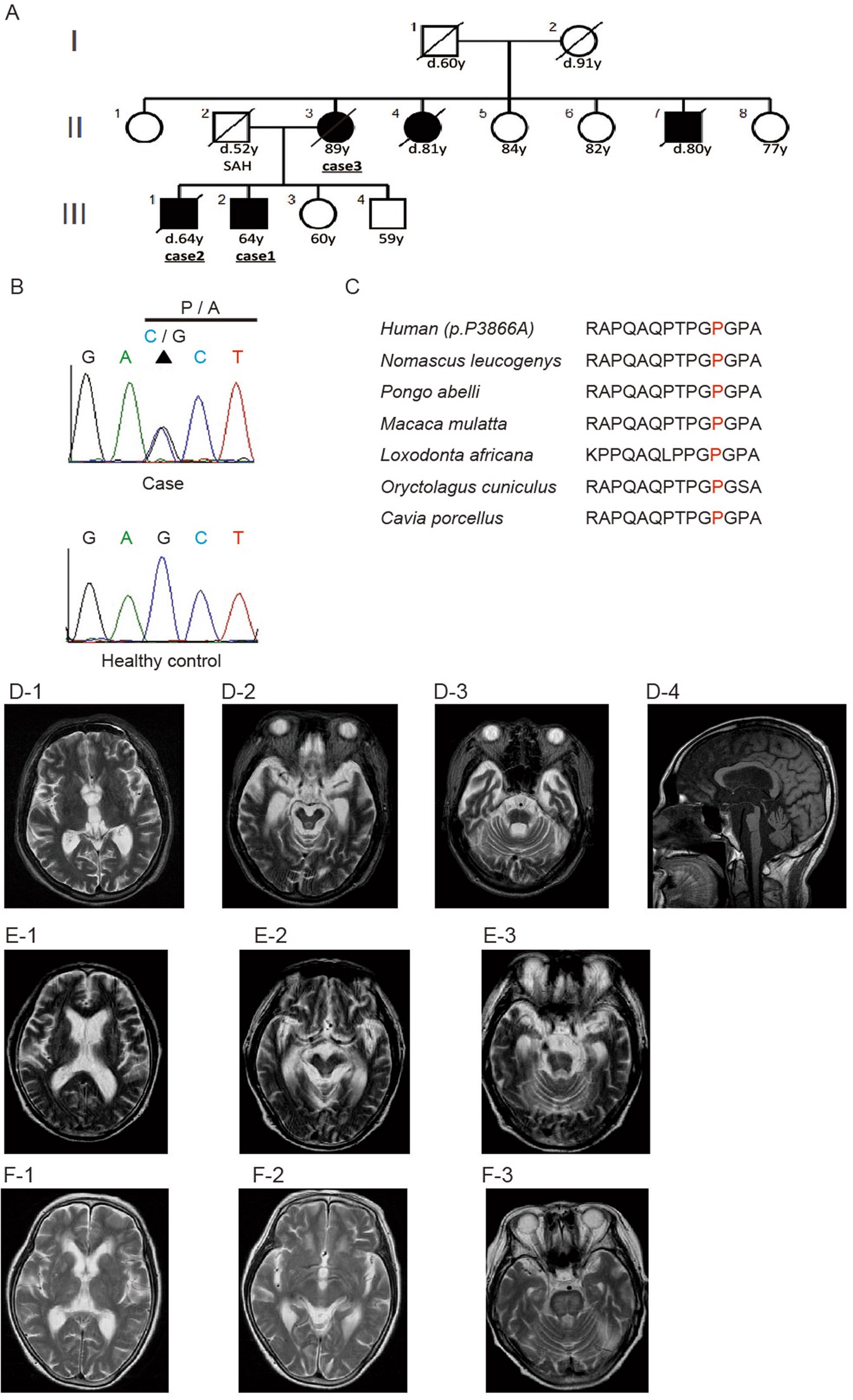 Mutations In Bassoon In Individuals With Familial And - 