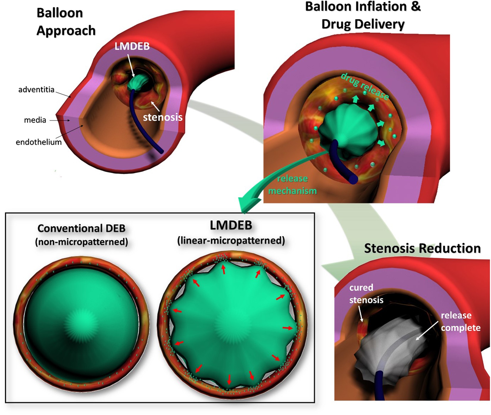 Linear Micro-patterned Drug Eluting Balloon (LMDEB) for Enhanced  Endovascular Drug Delivery | Scientific Reports