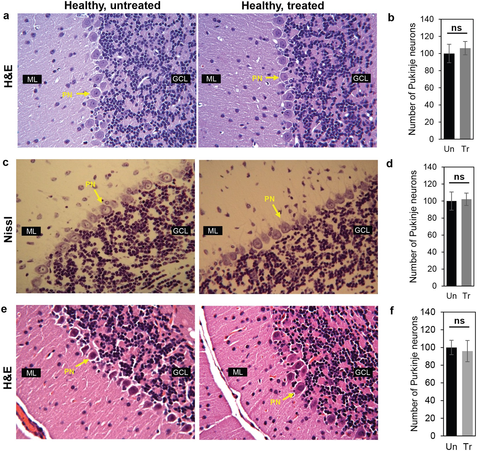 Treatment outcomes following continuous miglustat therapy in