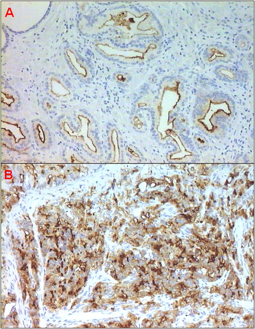 pathology prostate cancer johns hopkins