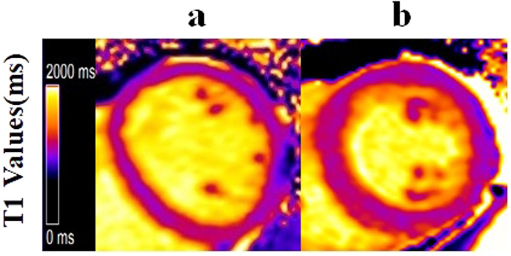 Diffuse Myocardial Injuries Are Present In Subclinical - 