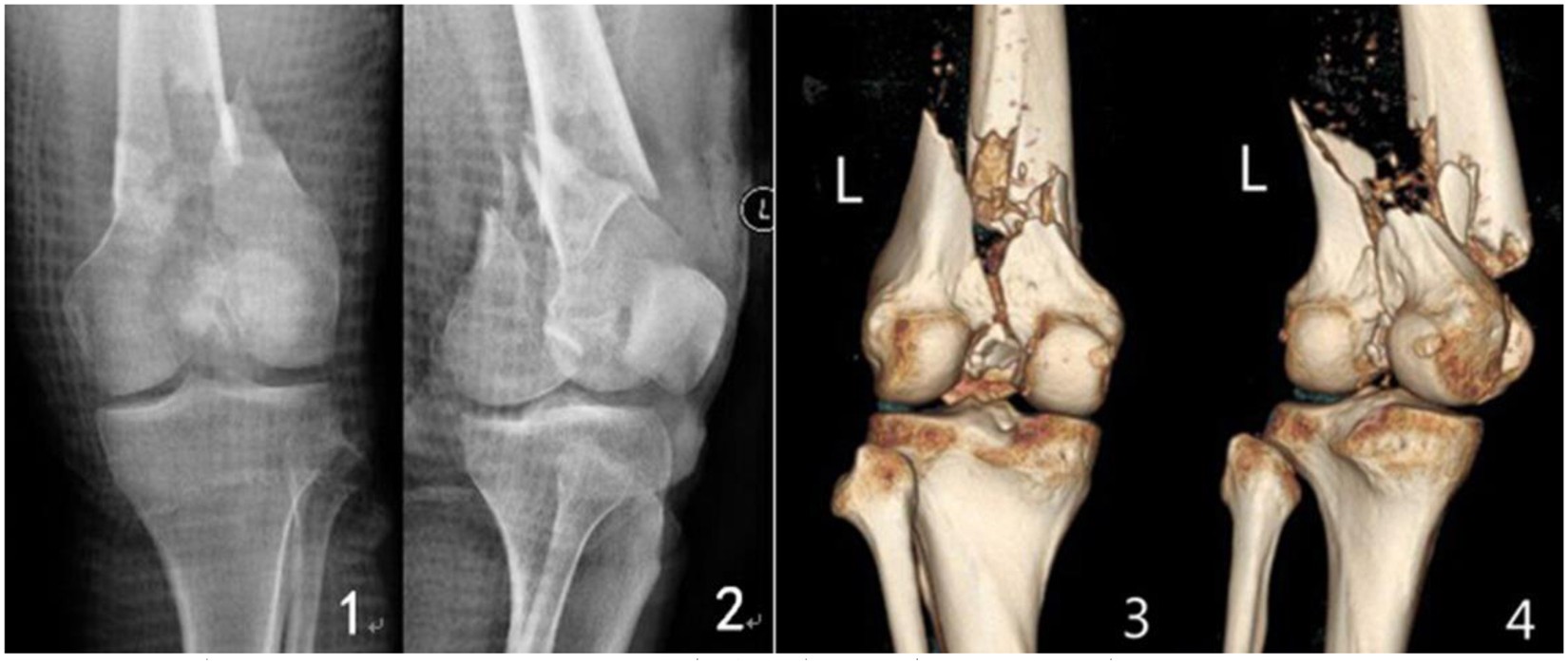 Evolution of Intramedullary Nails for Long Bone Fractures in the Lower Limb  | SpringerLink