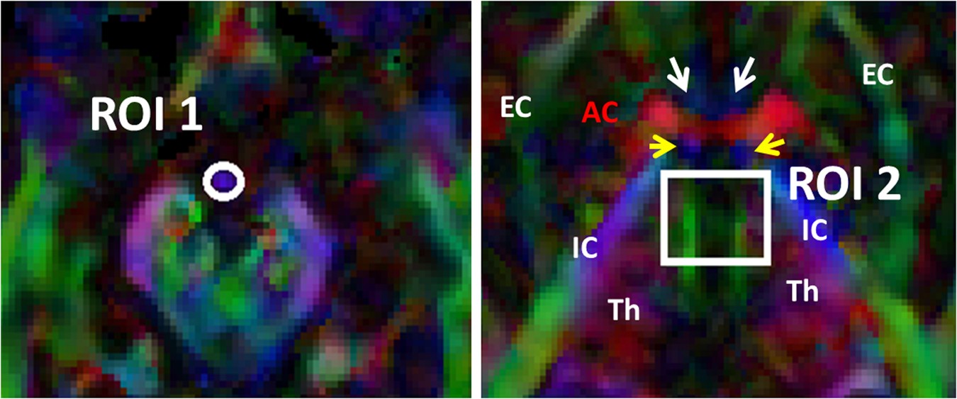 Diffusion Tensor Tractography Of The Mammillothalamic Tract - 
