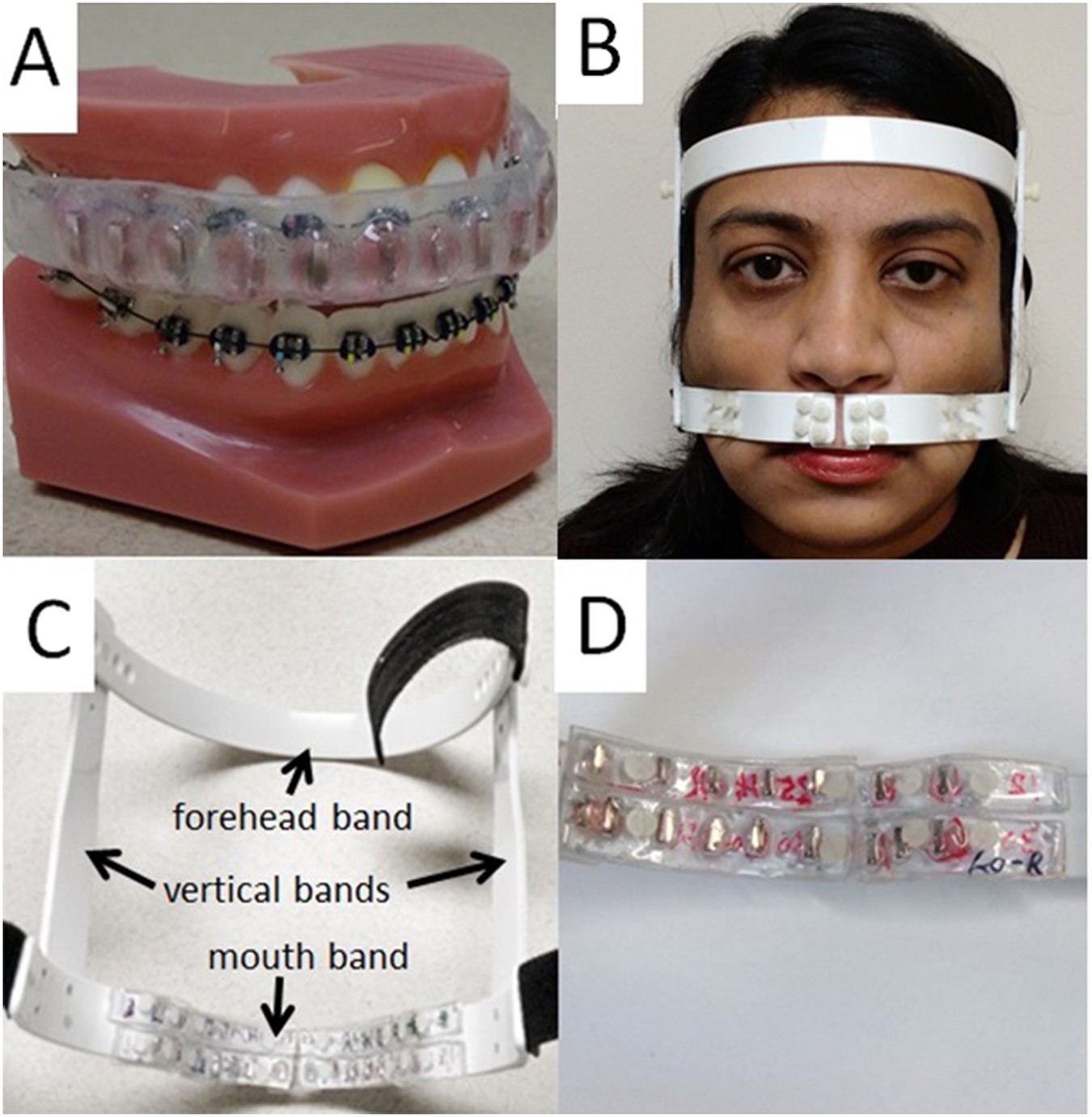 Braces Wire Thickness Chart