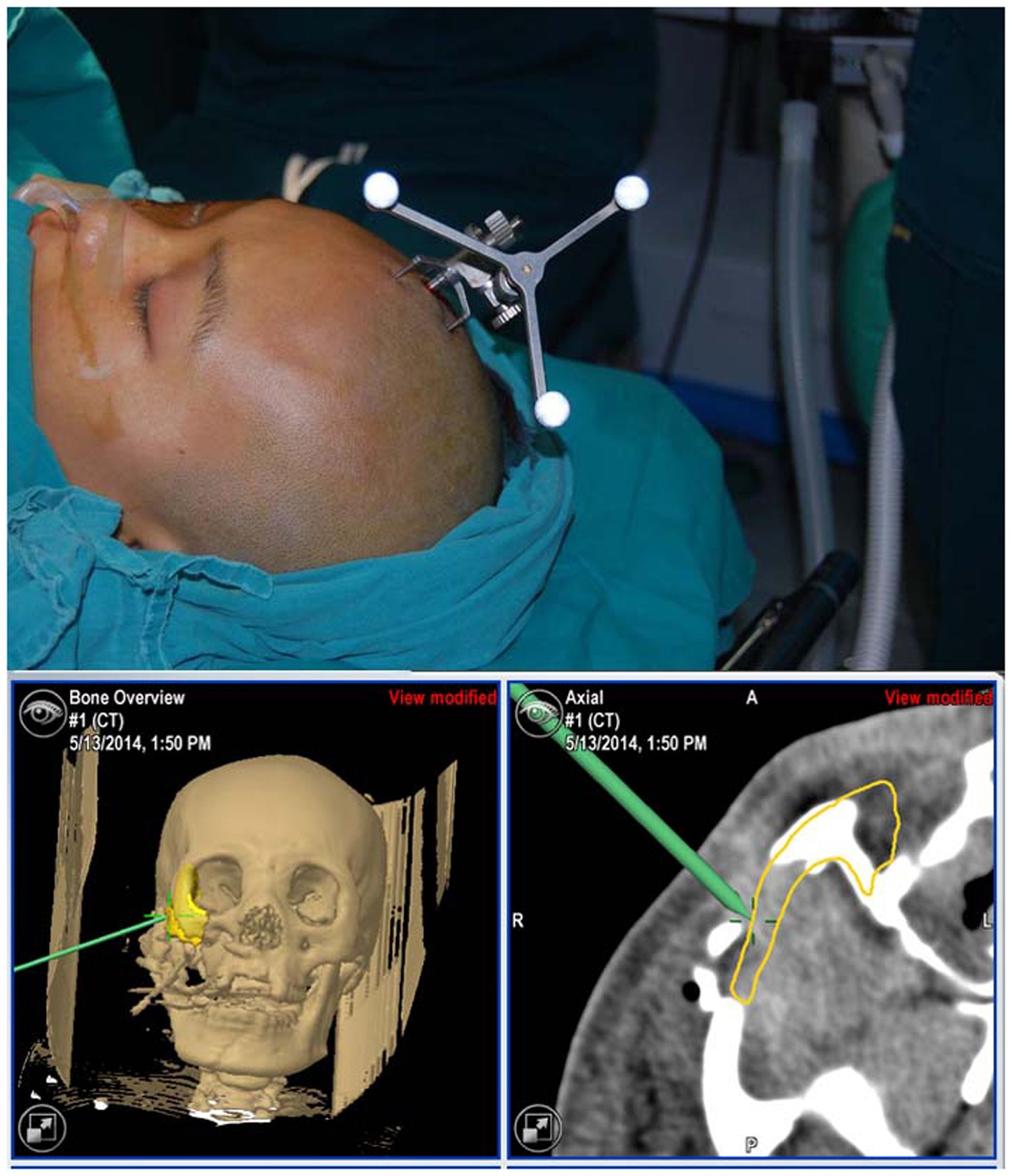 Surgical Navigation Improves Reductions Accuracy Of Unilateral